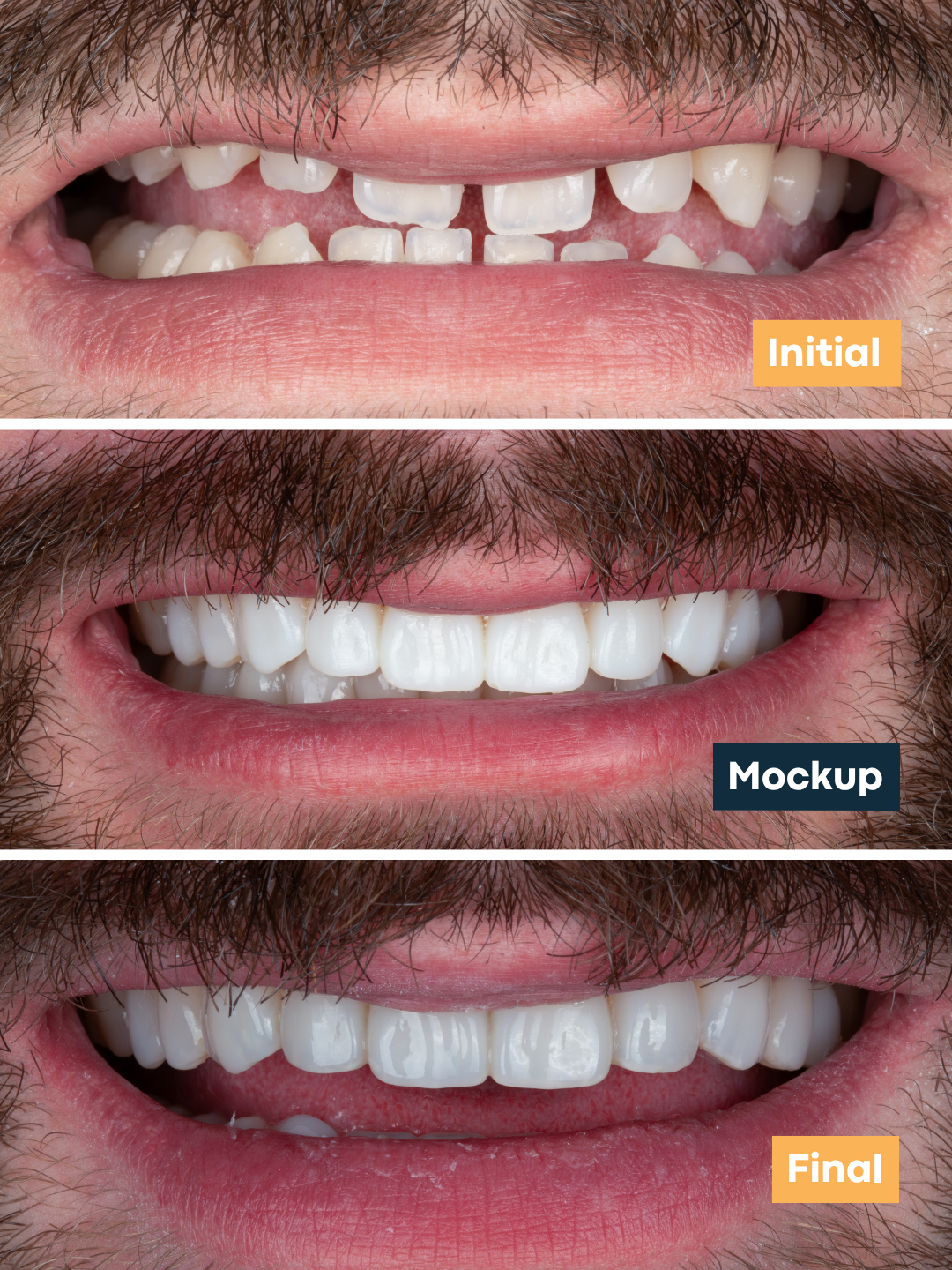 Clinical case Composite Veneers